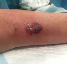 Image result for Pathergy