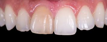 Image result for Tooth Discoloration