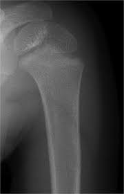 Image result for Humerus Growth Plates
