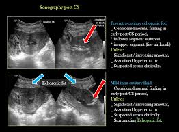 Normal Vs Abnormal Post Operative Sonography Post Cs If Infection Like Endometritis Or Parametritis Parametrium Connective Uterus Sonography Ultrasound