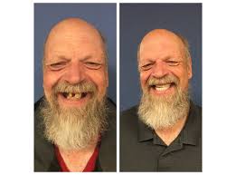 The cost of dental implants can vary depending on where you live due to. Dental Grants Colorado Gerontological Society