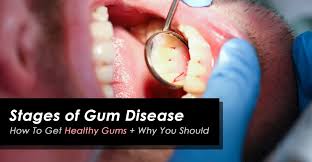 Tell your dentist if you recognize any of these symptoms of. Gum Disease How To Get Healthy Gums Teeth Larry Saylor Dentistry