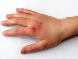 1st, 2nd, 3rd and 4th degree burns explained along with presentation and pathology. How To Treat Burns At Home And When To Seek Medical Treatment
