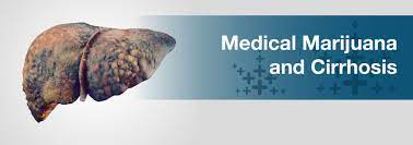 Medical Marijuana For Cirrhosis Marijuana Doctors