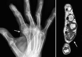 Image result for Chondrosarcoma