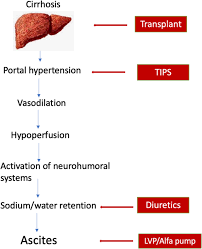 Image result for Ascites