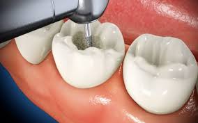 Stick with mild, soft food, as previously mentioned. How An Endodontist Can Save You With Tooth Saving Root Canal Procedure West Cobb Dentistry