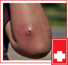 Image result for Skin Abscess