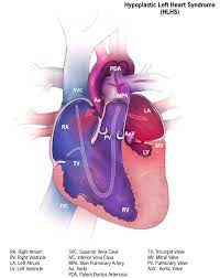Hypoplastic Left Heart Syndrome Wikipedia