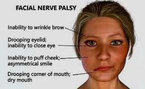Acupuncture recommendations for Bell's palsy treatment