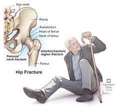 Symptoms of needing a hip replacement. Hip Fracture Broken Hip