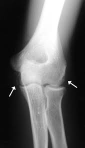 Traumatic and congenital joint incongruities, congenitally unstable fragments, fracture, and luxation occur in the elbow. Avulsion Fracture Of The Medial And Lateral Epicondyles Of The Humerus Sciencedirect