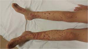 When myocarditis occurs, it's often after various types of viral infection, from the common cold to gastrointestinal illness. Myocarditis And Intracardiac Thrombus Due To Henoch Schonlein Purpura Case Report And Literature Review Springerlink