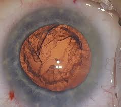 Image result for Cataract Extraction