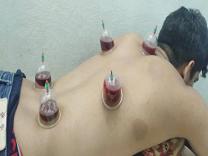Hijama Therapy product image