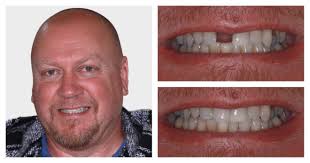 Dental Implants Testimonials