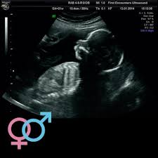 Gender Scans: Should I Find Out the Sex of My Baby?