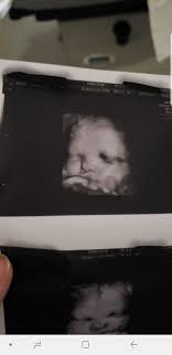 Down Syndrome October 2018 Babies Forums What To Expect