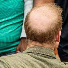 massive bald patch at Invictus Games ...