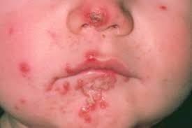 Image result for yellow scabs on the face in children