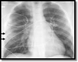 Image result for Pulmonary Contusion