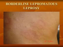 The prevalence of the same alleles among 50 healthy controls was 13/50 (26%). Leprosy Ppt Video Online Download