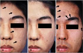 Image result for Diffuse Hyperpigmentation