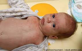 Ringelroteln Erythema Infectiosum Symptome Diagnostik Therapie Gelbe Liste