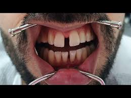 Diş implantları diş eksikliğinde, çene kemiği üzerine yerleştirilen titanyumdan yapılan vidalardır. Genis On Dis Araliginin Dis Kesilmeden Fiber Bonding Ile Kapatilmasi Ayrik Dis Tedavisi Youtube