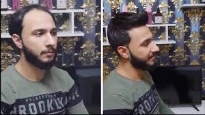 Bulut Protez Sac Merkezi Acilisa Ozel Quantum Plus 3000 Tl Vade Farksiz 12 Taksit Facebook