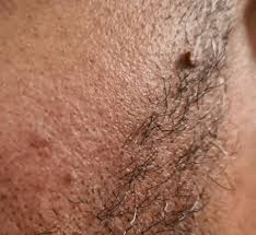 When these little growths appear on or around your eyes, you can feel particularly. Skin Tag Removal Surgery 175 Learn More About Skin Tags