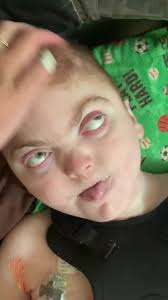 Managing magnesium-caused diarrhea in wheelchair users?