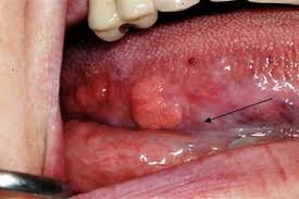 Image result for papillomavirus tongue)