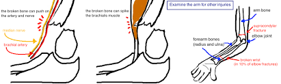 This page is for pediatric patients; Kids Broken Elbow Supracondylar Fracture Bone Talks