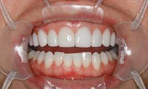 After This Is A Veneer Case To Change The Shape Of The Teeth Even Out The Gumline And Also The Front Left Tooth Was Ext Cosmetic Dentistry Dentistry Implants