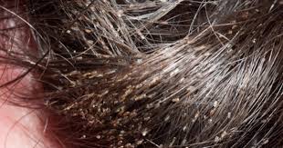 Brasil - Menina de 9 anos morre após 'infestação de piolhos', mãe e avó são presas... Ver mais | Facebook