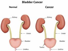 Image result for Bladder Cancer