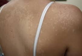 Check spelling or type a new query. Pityriasis Versicolor