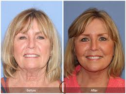 Pin On Before And After Pictures
