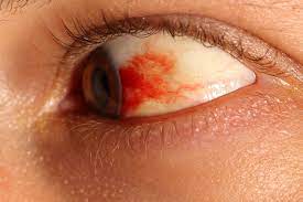 When it comes to common causes, dramatic spikes in blood pressure are a major one. What You Need To Know About Subconjunctival Hemorrhages Orchard Park Optometry