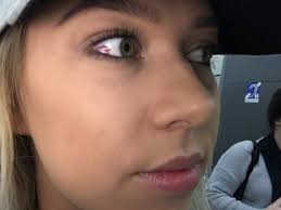 What causes subconjunctival hemorrhage after drinking?