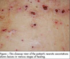 Image result for Neurotic Excoriation