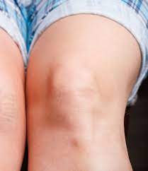 How Can I Treat Dark Knees And Elbows