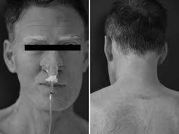 Esophageal Achalasia Induced by Ipilimumab and Nivolumab Combination: A  Rare Neurological Manifestation of Immune-related Autono