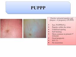 Image result for pruritic urticarial papules and plaques of pregnancy