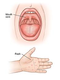 Image result for Hand foot and mouth disease HFMD roof of mouth