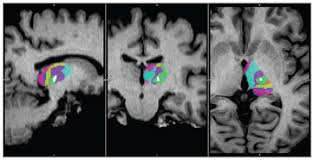 Image result for Thalamotomy