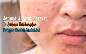 Jerawat bukan hanya pada anak remaja sahaja. Cara Hilangkan Parut Jerawat Untuk Wajah Kembali Cantik Ohcantik Com