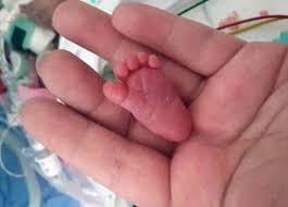 Eis o essencial sobre a 6ª. Conheca O Menor Bebe Do Mundo Emilia Nasceu Com 0 22 Kg Noticias Que Vao Mudar O Mundo