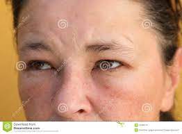 Allergies Swollen Eyes And Face Stock Image Image Of Common Health 19388741